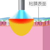 図：レーザー装置で下粘膜表面を熱で変性させる
